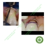 Bộ đê bảo vệ nướu khi mài cùi Zekrya Gingival Protector Kit Dentsply