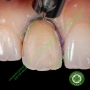 Bộ đê bảo vệ nướu khi mài cùi Zekrya Gingival Protector Kit Dentsply