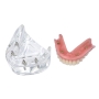 Mẫu hàm tư vấn implant All on 4 và phục hình tháo lắp trên implant
