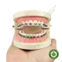 Mẫu hàm tư vấn chỉnh nha mắc cài kim loại và các loại khí cụ