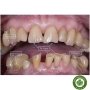Composite lỏng trám răng Mani Flo-V