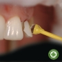 OptraStick Dụng cụ hỗ trợ đặt phục hình Veneer/ Inlay với đầu dính linh hoạt