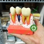 Mẫu hàm tư vấn so sánh răng cắm implant và cầu răng sứ
