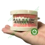 Mẫu hàm tư vấn chỉnh nha mắc cài kim loại và các loại khí cụ