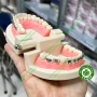Mẫu hàm tư vấn chỉnh nha mắc cài kim loại và các loại khí cụ