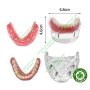 Mẫu hàm tư vấn implant All on 4 và phục hình tháo lắp trên implant