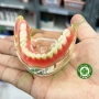 Mẫu hàm tư vấn implant All on 4 và phục hình tháo lắp trên implant