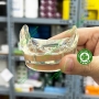 Mẫu hàm tư vấn implant All on 4 và phục hình tháo lắp trên implant