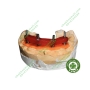 Vật liệu làm khóa chuyển implant - Nhựa tự cứng implant Pattern Resin LHKDent