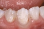 Đai cellulose nhựa - Đai nhựa trám răng Elite Matrix Strips