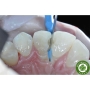 Đai cellulose kim loại - Đai kim loại trám răng Elite Matrix Band