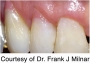 Composite đặc màu nướu Beautifil II Gingiva Shofu